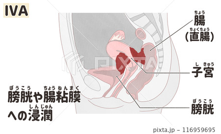 子宮体がん ステージⅣA(4A期) わかりやすい日本語図解イラスト 子宮体がん ステージⅣA(4A期) わかりやすい日本語図解イラスト 116959695