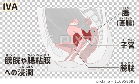 子宮体がん ステージⅣA(4A期) わかりやすい日本語図解イラスト 子宮体がん ステージⅣA(4A期) わかりやすい日本語図解イラスト 116959695