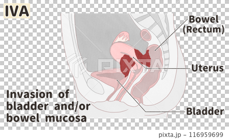 Uterine cancer stage IVA (stage 4A) - Easy-to-understand English illustrations 116959699