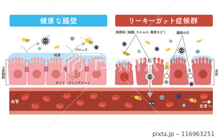 リーキーガット症候群のイラスト（文字あり） 116963251