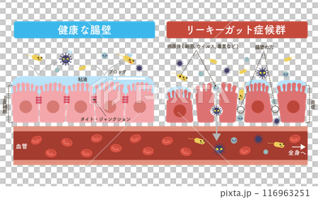 リーキーガット症候群のイラスト（文字あり） 116963251