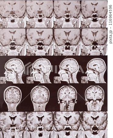 Magnetic resonance imaging of the head of a healthy person, image of the pituitary gland. 116964596