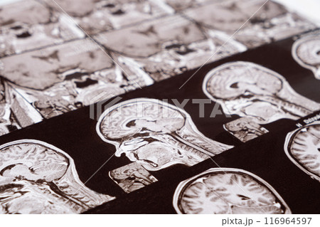 Magnetic resonance imaging of the head of a healthy person, image of the pituitary gland. 116964597
