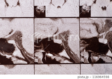 Magnetic resonance imaging of the head of a healthy person, image of the pituitary gland. Magnetic resonance imaging of the head of a healthy person, image of the pituitary gland. 116964598