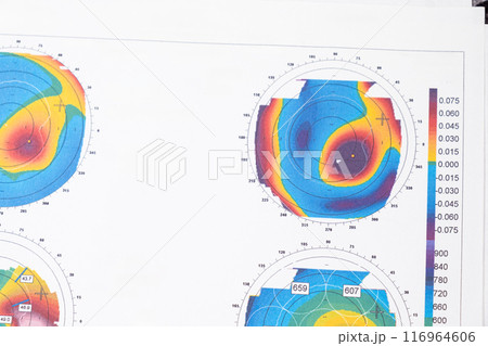 Results of the examination of the thickness and curvature of the cornea in a patient with keratoconus. Results of the examination of the thickness and curvature of the cornea in a patient with keratoconus. 116964606