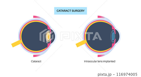 Intraocular lenses poster Intraocular lenses poster 116974005