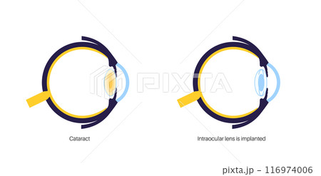 Intraocular lenses poster 116974006