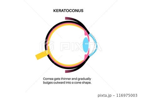 Cataract eye disease Cataract eye disease 116975003
