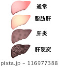 肝硬変 116977388