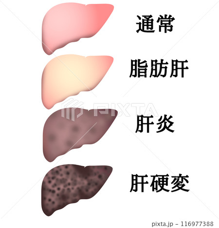 肝硬変 116977388