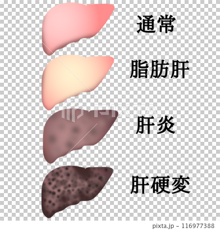 肝硬変 116977388