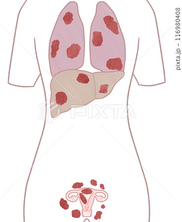 子宮体がん ステージⅣB(4B期) わかりやすい図解イラスト 子宮体がん ステージⅣB(4B期) わかりやすい図解イラスト 116980408