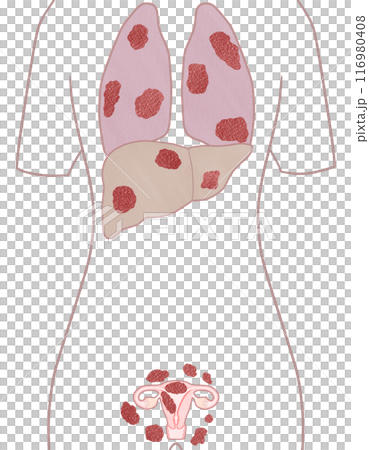 子宮体がん ステージⅣB(4B期) わかりやすい図解イラスト 子宮体がん ステージⅣB(4B期) わかりやすい図解イラスト 116980408