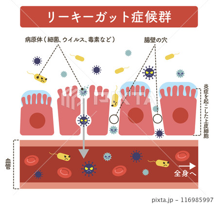 リーキーガット症候群のイラスト（文字あり） 116985997