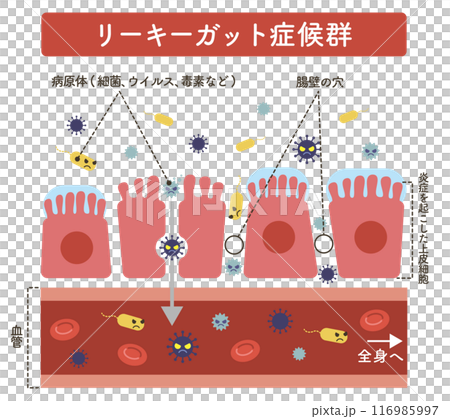 リーキーガット症候群のイラスト（文字あり） 116985997