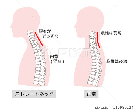 正常とストレートネックの上半身の比較説明イラスト 正常とストレートネックの上半身の比較説明イラスト 116989124