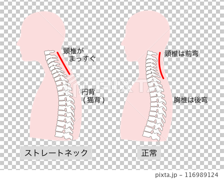 正常とストレートネックの上半身の比較説明イラスト 正常とストレートネックの上半身の比較説明イラスト 116989124