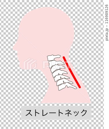 Illustration of the cervical vertebrae in a straight neck 116989126