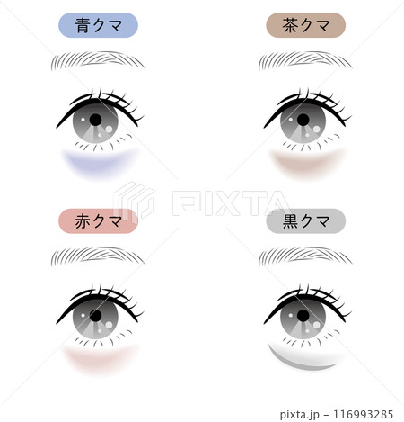 目の下のクマの種類 目の下のクマの種類 116993285