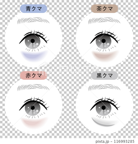 Types of dark circles under the eyes 116993285