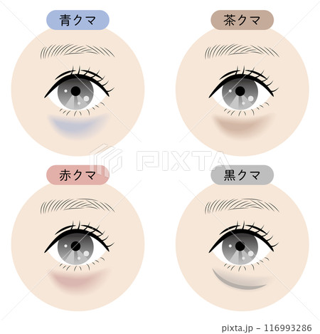 目の下のクマの種類 目の下のクマの種類 116993286