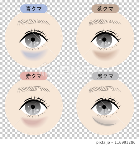 Types of dark circles under the eyes 116993286