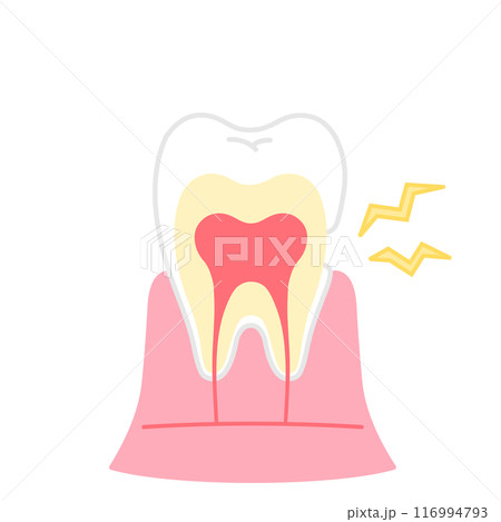 知覚過敏　歯の断面図のイラスト 116994793