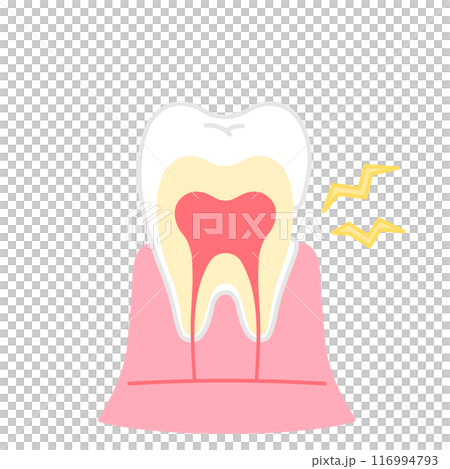 知覚過敏　歯の断面図のイラスト 116994793