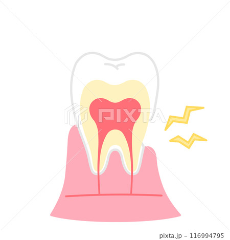 歯茎が下がって象牙質がむき出しのイラスト　知覚過敏　歯の断面図のイラスト 116994795