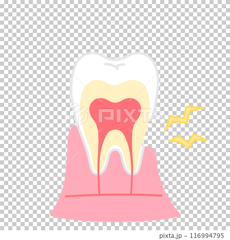歯茎が下がって象牙質がむき出しのイラスト　知覚過敏　歯の断面図のイラスト 116994795