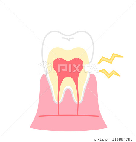 象牙質が削れているイラスト 知覚過敏 歯の断面図のイラスト 象牙質が削れているイラスト 知覚過敏 歯の断面図のイラスト 116994796