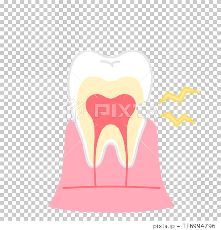 象牙質が削れているイラスト 知覚過敏 歯の断面図のイラスト 象牙質が削れているイラスト 知覚過敏 歯の断面図のイラスト 116994796