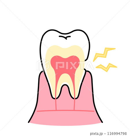象牙質がむき出しのイラスト　知覚過敏　歯の断面図のイラスト 116994798
