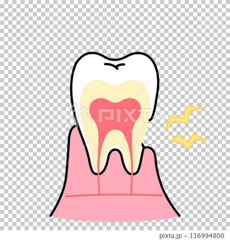 Illustration of receding gums exposing dentin, tooth sensitivity, cross-section of tooth 116994800