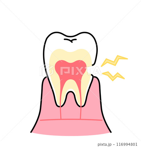 象牙質が削れているイラスト　知覚過敏　歯の断面図のイラスト 116994801