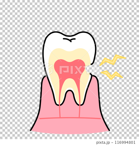 Illustration of worn dentin, tooth sensitivity, cross-section of tooth 116994801