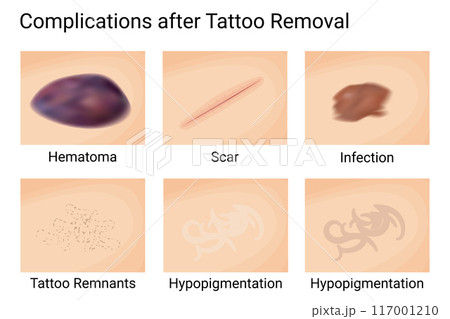 Skin Complications Post Tattoo Removal. Vector illustration design. 117001210