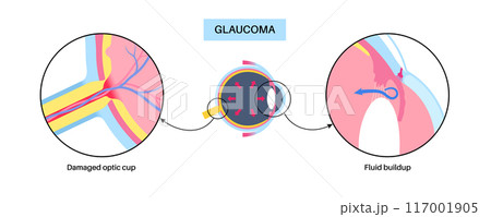 Glaucoma eye disease 117001905
