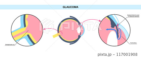 Glaucoma eye disease Glaucoma eye disease 117001908