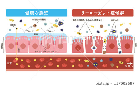 リーキーガット症候群のイラスト 栄養素と未消化の栄養素の追加 リーキーガット症候群のイラスト 栄養素と未消化の栄養素の追加 117002697