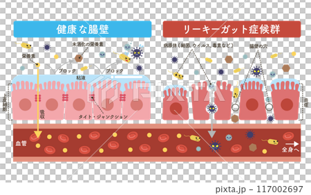 リーキーガット症候群のイラスト 栄養素と未消化の栄養素の追加 リーキーガット症候群のイラスト 栄養素と未消化の栄養素の追加 117002697