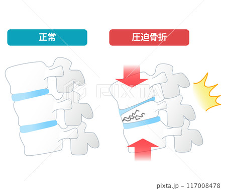 骨粗鬆症による脊椎圧迫骨折の仕組み 117008478