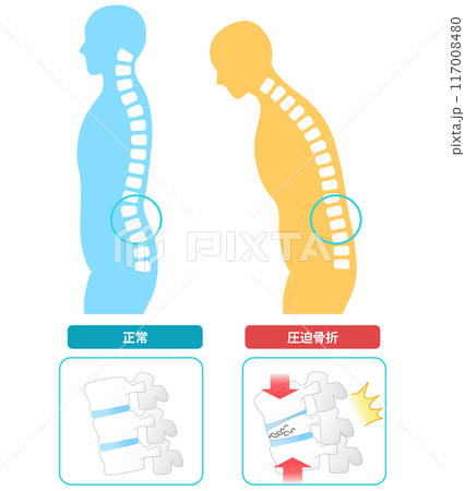 横から見た骨粗鬆症による脊椎圧迫骨折の仕組みのイラスト素材