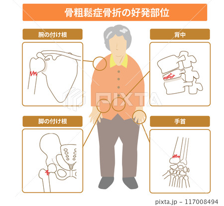 骨粗鬆症になると骨折しやすい部位と高齢女性の全身イラスト 骨粗鬆症になると骨折しやすい部位と高齢女性の全身イラスト 117008494