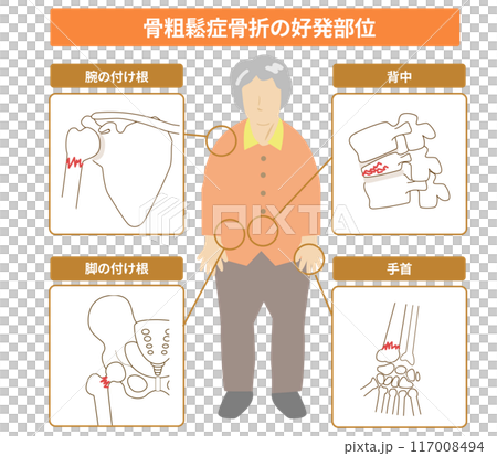 Illustration of areas prone to fractures due to osteoporosis and a full-body view of an elderly woman 117008494