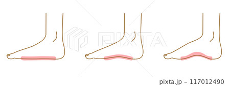 足のアーチ：側面イラストセット（正常とアーチ崩れ） 117012490