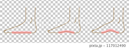 足のアーチ：側面イラストセット（正常とアーチ崩れ） 117012490