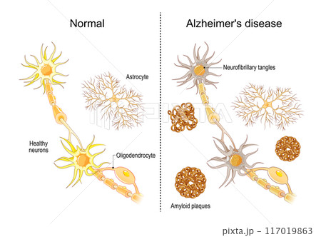 Alzheimer disease. Neurons and Dementia. Alzheimer disease. Neurons and Dementia. 117019863