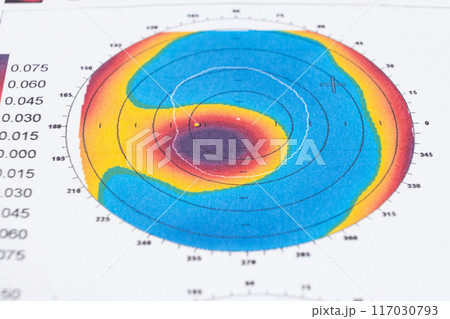 Results of the examination of the thickness and curvature of the cornea in a patient with keratoconus 117030793