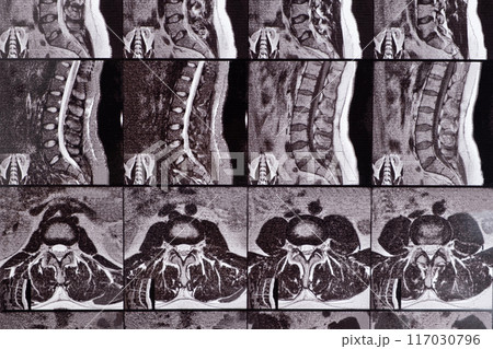 MRI of a patient with intervertebral disc protrusion and osteochondrosis of the thoracic spine MRI of a patient with intervertebral disc protrusion and osteochondrosis of the thoracic spine 117030796